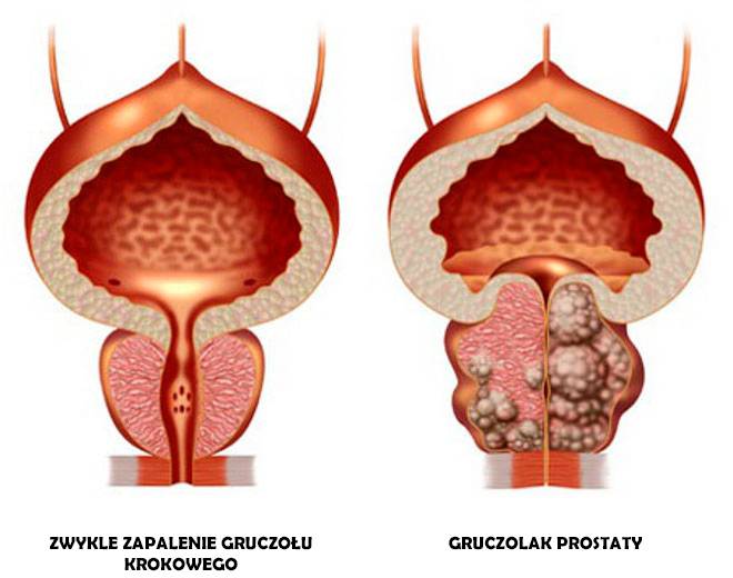 prostata